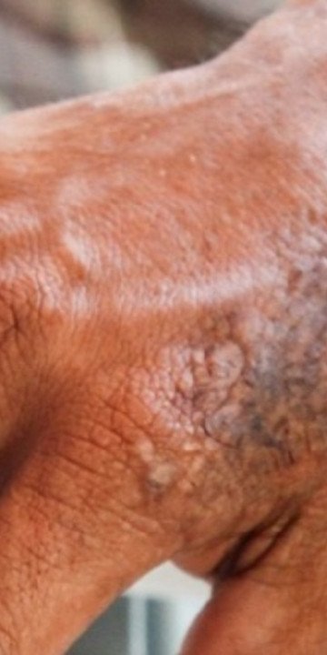 Salta registra 11 casos de lepra