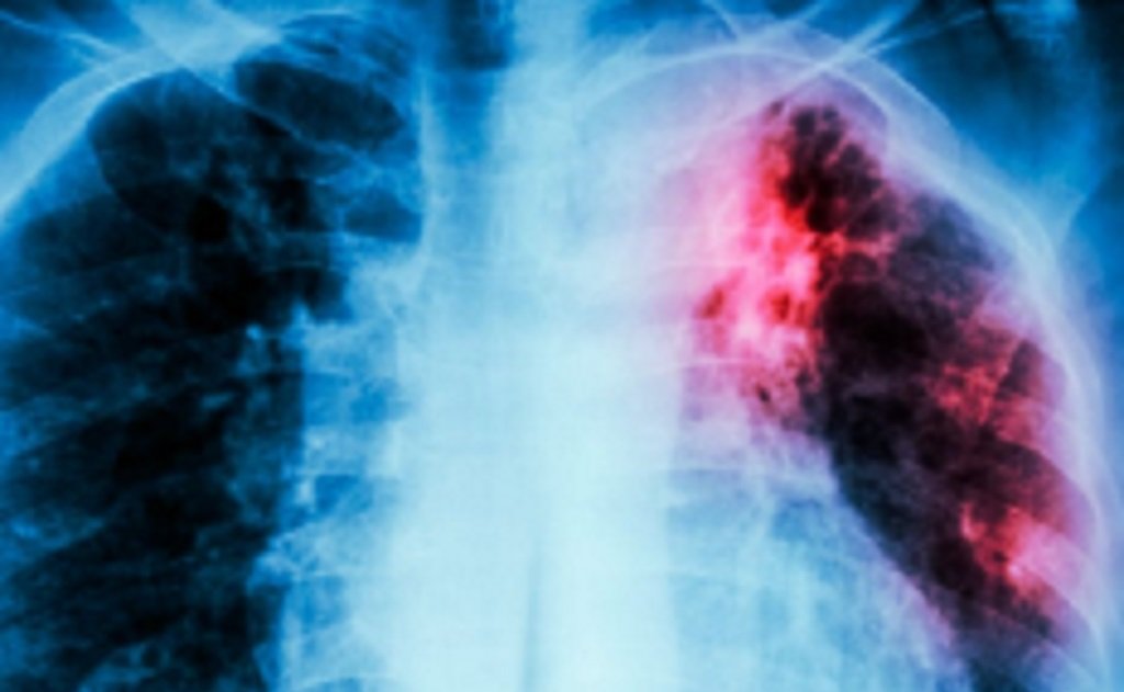 En 2025 se notificaron 884 casos de tuberculosis en Salta