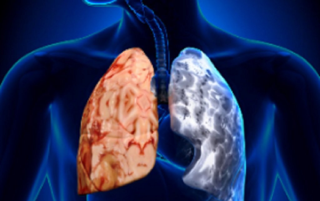 Realizarán espirometrías gratuitas para diagnosticar la EPOC